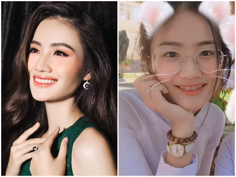 Hoa hậu Ý Nhi không ngần ngại chia sẻ những bức ảnh khi còn đeo niềng. Ảnh: FBNV.