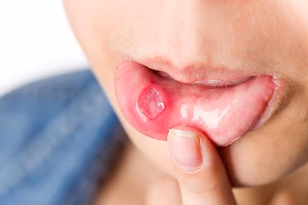 Loét miệng kéo dài. Niêm mạc miệng rất nhạy cảm nên thi thoảng sẽ xuất hiện tình trạng loét. May mắn thay, những vết loét thông thường thường tự lành trong 1-2 tuần. Ngược lại, nếu đối diện tình trạng thường xuyên loét miệng, loét miệng kéo dài hơn 2 tuần không khỏi thì cần đi khám để tìm hiểu nguyên nhân chính xác.