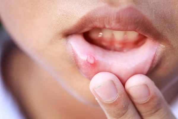 Loét miệng do ung thư thường xuất hiện ở bụng lưỡi, mép lưỡi, rãnh má, khóe miệng, vòm miệng. Vết loét có thể nông hoặc sâu, có gờ nổi lên, nhân trung không đều, cứng, bao phủ bởi lớp mô hoại tử. Đôi khi có thể kèm theo các hạch bạch huyết sưng ở vùng dưới hàm hoặc cổ.