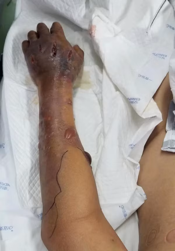 Rua ca, lao ngu nhiem vi khuan xam nhap, buoc cat bo 1 chi