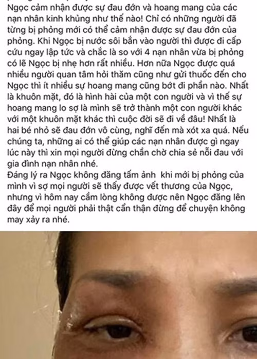 Ngỡ ngàng nhan sắc của Hồng Ngọc sau 3 năm bị bỏng Ngo ngang nhan sac cua Hong Ngoc sau 3 nam bi bong