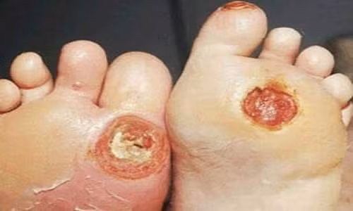 Bàn chân dễ bị ăn mòn do biến chứng tiểu đường.