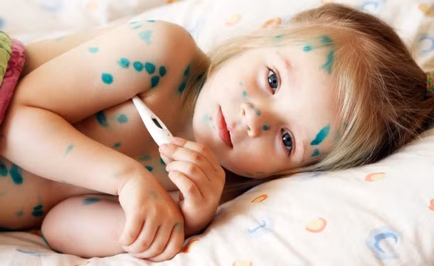 Các mụn nước này mọc làm nhiều đợt khác nhau nên trên cùng một vùng da có thể thấy nhiều dạng khác nhau: đỏ rát, mụn nước trong, mụn nước đục, mụn đóng vẩy… 