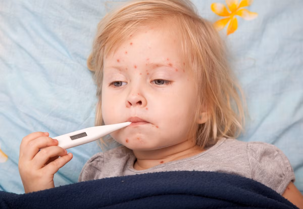 Bệnh nhân sẽ có cảm giác ngứa, khó chịu nhưng tuyệt đối không được gãi để vỡ các mụn nước, sẽ khiến mụn mọc nhiều hơn, dễ để lại sẹo sâu và rất có khả năng gây biến chứng nguy hiểm.
