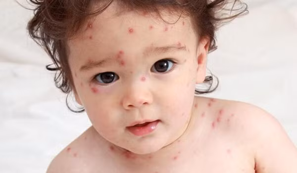Giai đoạn thứ 3, các vết mụn đóng vẩy: Nếu không có biến chứng thì đây là giai đoạn phục hồi của người bệnh. Sau 1-2 tuần, bệnh nhân có thể dần phục hồi, giảm sốt, đỡ mệt mỏi, hết đau họng… 