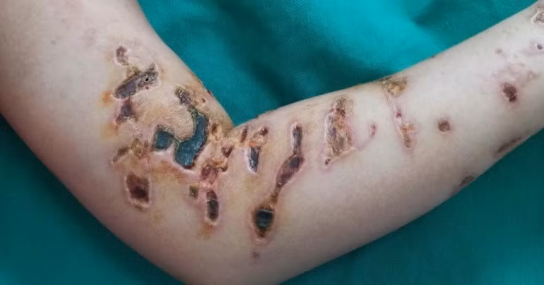 Khi tắm biển bị sứa đốt, tuyệt đối không làm điều này Khi tam bien bi sua dot, tuyet doi khong lam dieu nay