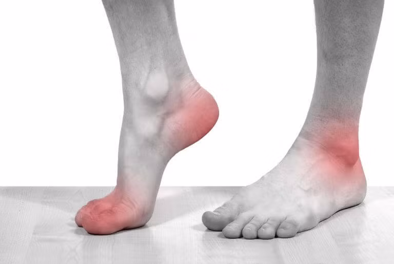 Có thể mất khả năng vận động: Người bệnh gout có thể bị biến dạng xương khớp, hình thành nên cục tophi do tinh thể urate lắng đọng trong mô mềm nếu trong trường hợp bệnh tiến triển nặng và trở nên mãn tính.