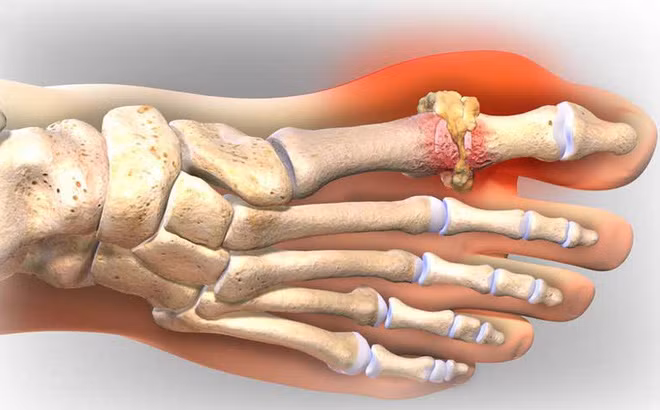Bệnh gout do nhiều nguyên nhân gây ra như tăng bẩm sinh: Do ngay từ nhỏ, cơ thể người bệnh bị thiếu men HGPT do đó lượng acid uric không ổn định sẵn. Đây là trường hợp rất hiếm gặp nhưng khi gặp thì bệnh lại rất nặng, rất khó phát hiện và điều trị.