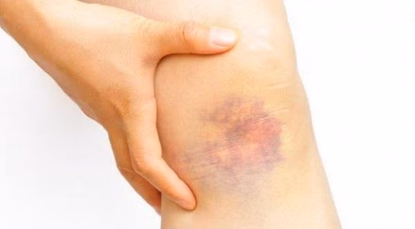 Nếu vết bầm xuất hiện không rõ lý do cũng như chẳng hề có cảm giác đau đớn, bạn đừng nên chủ quan vì đó có thể là dấu hiệu của một một số bệnh nguy hiểm.