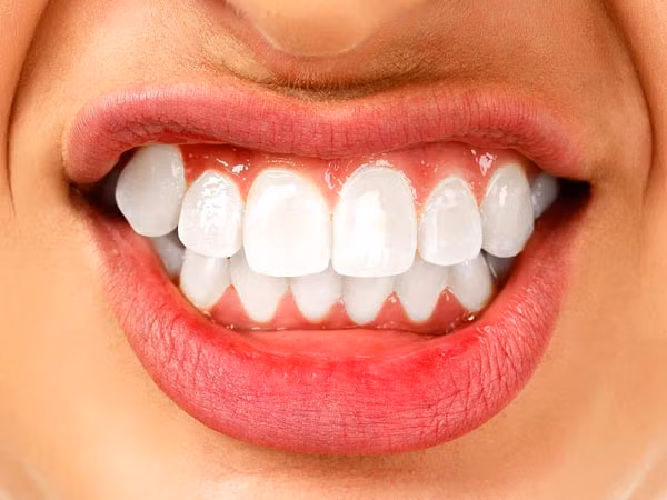 6. Nghiến răng thường là do thói quen ngủ hoặc căng thẳng. Thói quen hại răng này rất khó kiểm soát.