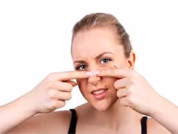 Thói quen nặn mụn chỉ thúc đẩy vi khuẩn vào da sâu hơn và làm cho mụn nổi nhiều hơn. Điều này thậm chí lây lan vi khuẩn sang các bộ phận khác của khuôn mặt bạn.
