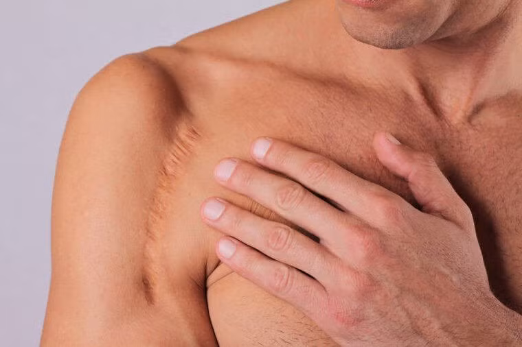 Tuổi càng lớn, vùng ngực của bạn sẽ xuất hiện nhiều mạch máu vỡ, vết nhăn và sự đổi màu.