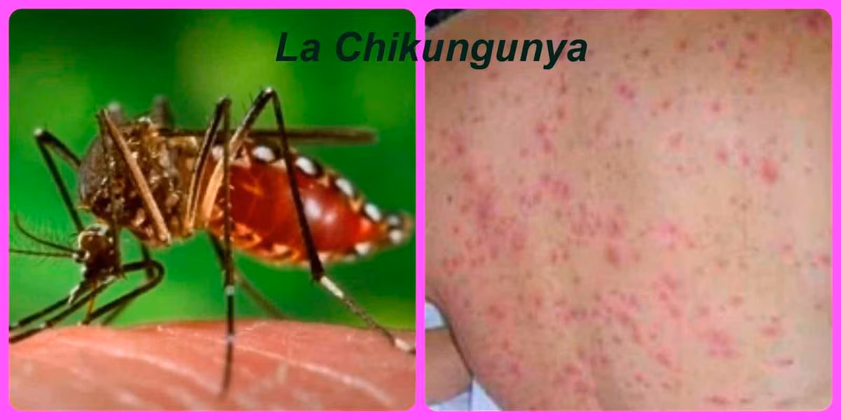 Sốt Chikungunya là bệnh do virus Chikungunya lây nhiễm qua trung gian muỗi. Các triệu chứng phổ biến của bệnh là nhức đầu, nôn mửa, đau lưng, phát ban da và đau khớp kéo dài một vài tuần.