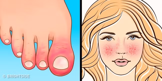 Mụn trứng cá, phát ban, vẩy nến, viêm da, chàm…có thể là những dấu hiệu của bệnh thiếu máu, hội chứng máu không đông, và các rối loạn khác liên quan đến hệ tạo máu và miễn dịch.