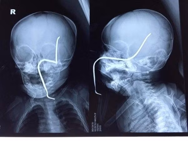Hình ảnh phim X-quang của cháu H cho thấy thanh sắt đâm vào gò má trái, xuyên lên vùng não thái dương.