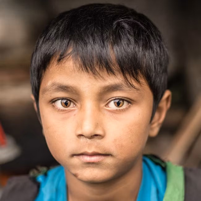 Cậu bé ở Nepal mắc hội chứng Mắt mèo.