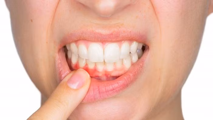 Bảo vệ nướu: Đánh răng hàng ngày không chỉ loại bỏ vi khuẩn từ răng mà còn giúp bảo vệ nướu răng - một phần quan trọng của sức khỏe răng miệng.