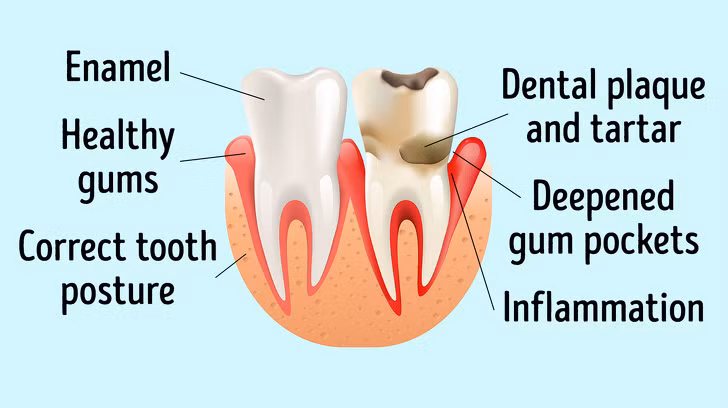 10. Răng nhiễm trùng: Các nhà nghiên đã chứng minh mối quan hệ giữa viêm nha chu và hội chứng mạch vành.