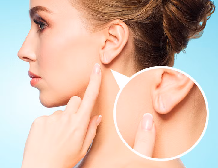 8. Nếp nhăn tai: Hơn 40 nghiên cứu xác nhận rằng nếp gấp thùy tai chéo, còn được gọi là dấu hiệu của Frank, cho thấy tăng nguy cơ xơ vữa động mạch.