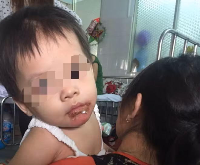 Bé gái 18 tháng bỏng nặng ở miệng, mẹ tố do bảo mẫu Be gai 18 thang bong nang o mieng, me to do bao mau
