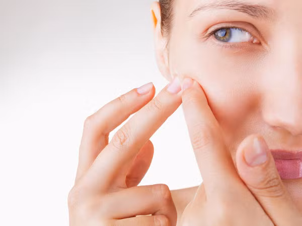 Nước hoa hồng trị mụn trứng cá. Trộn đều 1 muỗng cà phê nước hoa hồng và 1 muỗng cà phê nước chanh. Dùng bông thấm bôi lên da mỗi ngày để giảm mụn trứng cá và sẹo.