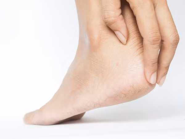 Nước hoa hồng và glycerin có thể được kết hợp để chữa nứt gót chân. Trộn lượng bằng nhau của nước hoa hồng và glycerin. Chà hỗn hợp này lên bàn chân mỗi ngày trước khi đi ngủ. Rửa sạch bằng nước ấm vào hôm sau.