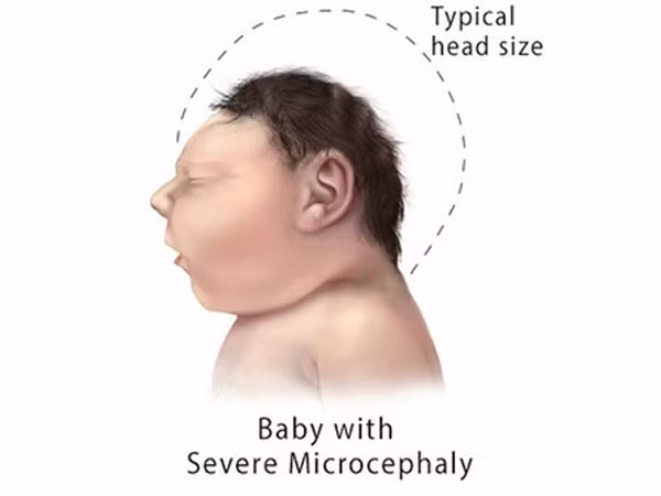 Microencephaly là một căn bệnh cực kỳ hiếm gặp khi não của một đứa trẻ không phát triển trong tử cung vì phơi nhiễm với bức xạ và các yếu tố chấn thương khác. Trẻ em bị bệnh này luôn bị bệnh tâm thần.
