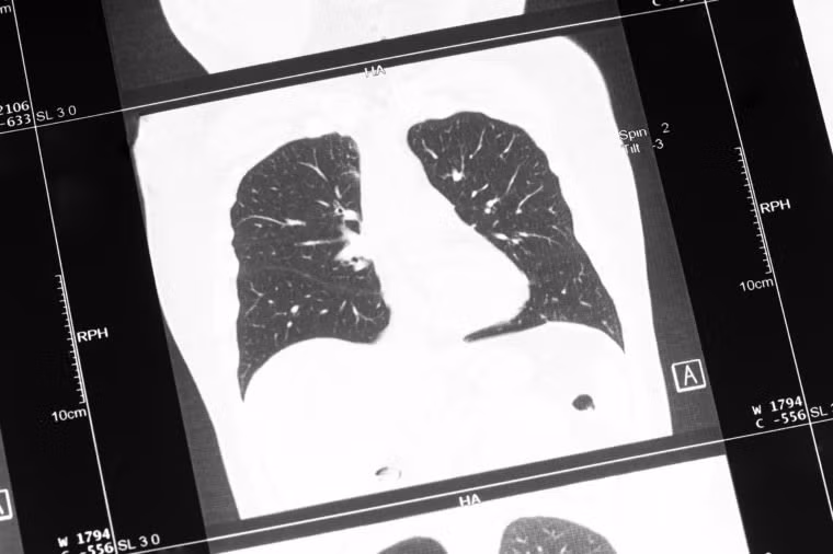 Bệnh phổi tắc nghẽn mãn tính (COPD) là một bệnh mãn tính và tiến triển tại phổi khiến cho người bệnh cảm thấy khó thở. Theo WHO, hằng năm có khoảng 3,1 triệu ca tử vong do mắc COPD, tương ứng với 5,6% trong tổng số trường hợp tử vong trên toàn thế giới.