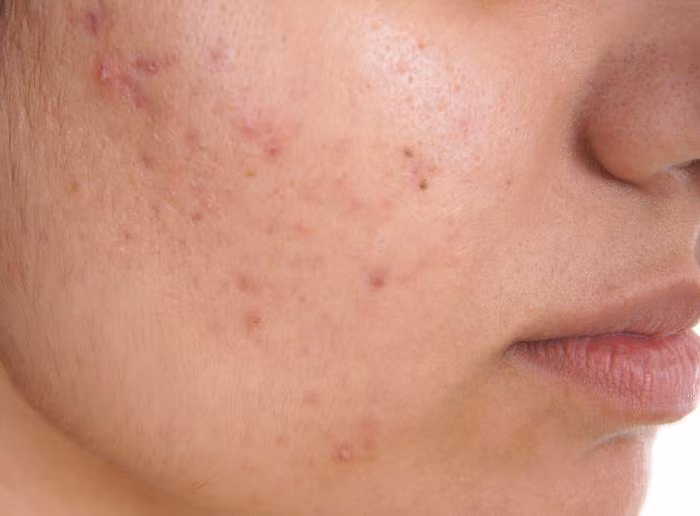 Giúp ngăn ngừa rối loạn da: Củ cải có đặc tính kháng khuẩn và kháng khuẩn. Chúng cũng chứa Vitamin C giúp trị mụn trứng cá. Bôi nước ép củ cải tươi lên vùng da bị mụn mỗi ngày chắc chắn sẽ cải thiện tình trạng rõ rệt.