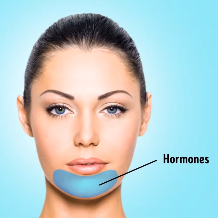 Mụn trứng cá ở vùng hàm và cằm thường là liên quan đến hormone, cụ thể là dư thừa của nội tiết tố nam androgen.
