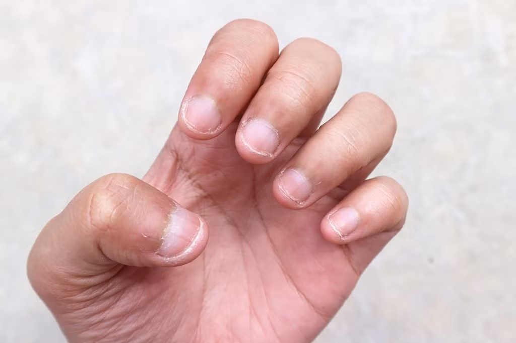 Cắn móng tay là một thói quen xấu có thể gây ra các chứng bệnh nguy hiểm và làm giảm tuổi thọ nếu thực hiện thường xuyên.