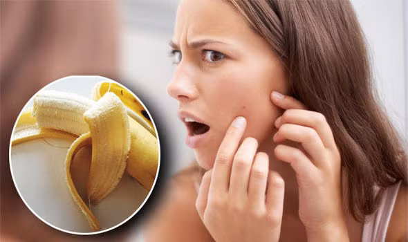 Trị mụn trứng cá và mờ sẹo: Mỗi buổi tối, thoa một vỏ chuối lên mặt, bạn cứ để như vậy đi ngủ. Sáng ra rửa lại mặt như bình thường. Bạn có thể áp dụng cách này cả tuần.