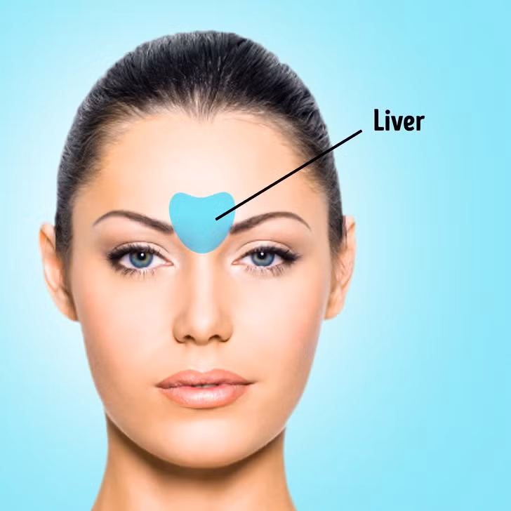 Mụn nổi lên giữa hai lông mày cảnh báo gan đang có vấn đề. Gan có rất nhiều chức năng, đóng vai trò quan trọng trong hệ tiêu hóa và chuyển hóa. Mụn giữa lông mày cảnh báo chế độ ăn uống của bạn không lành mạnh, ăn nhiều thực phẩm có dầu mỡ.