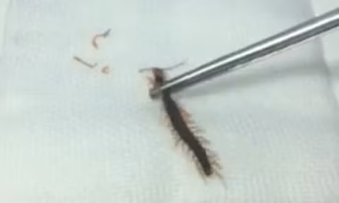 Con rết được các bác sĩ gắp ra. Con rết được các bác sĩ gắp ra.