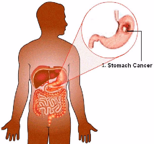 Giáo sư Gustaf Edgren của Viện Karolinska ở Thụy Điển nói rằng những người nhóm máu A có nguy cơ mắc ung thư dạ dày cao.
