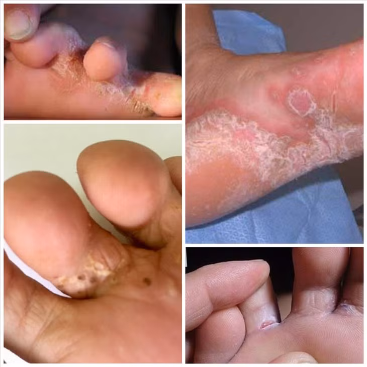Cách chăm sóc, phòng tránh bệnh da và nguy cơ bỏng mùa bão lũ Cach cham soc, phong tranh benh da va nguy co bong mua bao lu