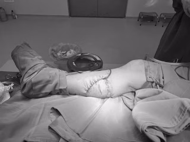 Tình trạng sức khỏe của người đàn ông bị bò giẫm nát chân Tinh trang suc khoe cua nguoi dan ong bi bo giam nat chan