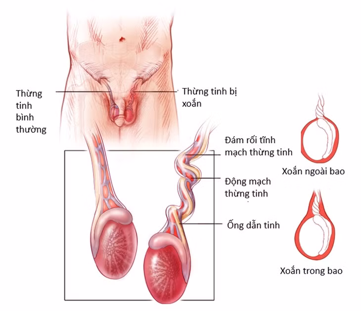 Thanh niên 16 tuổi bị xoắn tinh hoàn hoại tử Thanh nien 16 tuoi bi xoan tinh hoan hoai tu