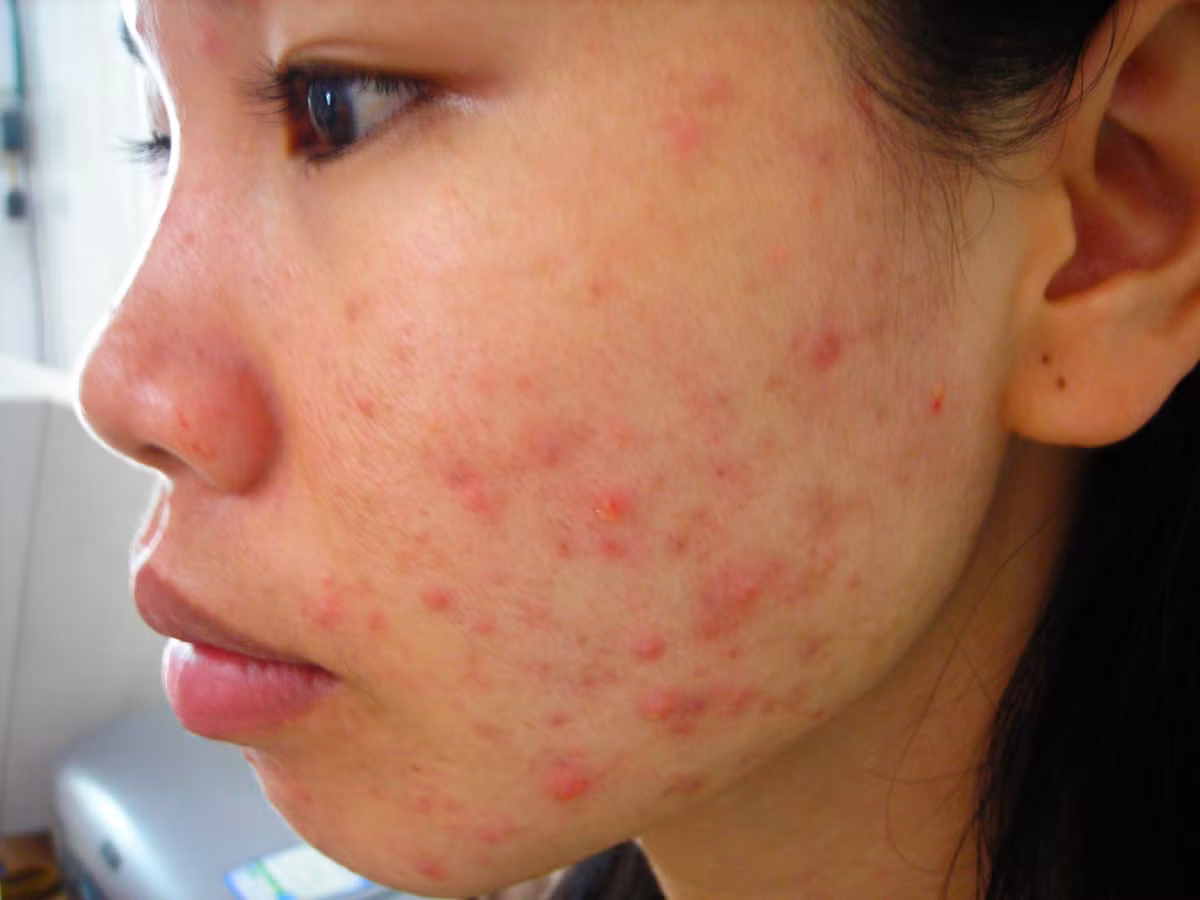 Bụi không khí do ô nhiễm là tác nhân gây các bệnh về da liễu như mụn, dị ứng, viêm da… 
