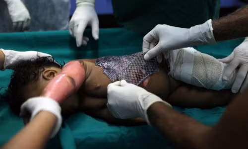 Độc đáo trị bỏng hiệu quả rẻ tiền bằng da cá rô phi Doc dao tri bong hieu qua re tien bang da ca ro phi