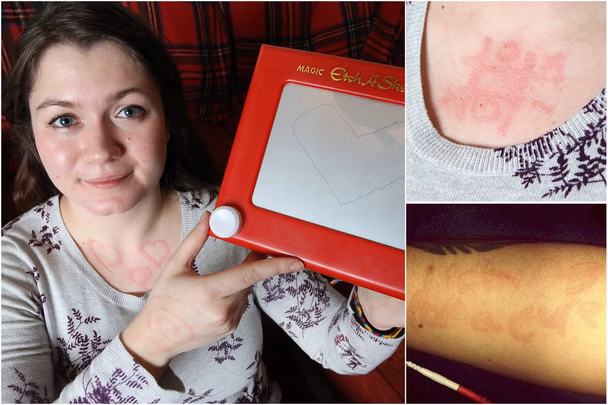 Cô gái Hannah Arbuthnott, 21 tuổi bị một dạng bệnh mề đay có tên dermatographia. Khi một người mắc chứng bệnh hiếm gặp dermatographia có một vết trầy xước trên da của mình, máu sẽ được gia tăng đưa đến nơi trầy xước hơn bình thường. Dermatographia có các triệu chứng như đỏ, ngứa và sưng.