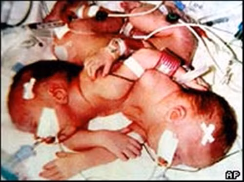 Hay một trong những ca mổ tách được dư luận chú ý nhiều nhất được thực hiện năm 1993 tại Mỹ; bệnh nhân là 2 chị em Angela và Amy Lakeberg, lúc đó 7 tháng tuổi, chung nhau một trái tim và một buồng gan.