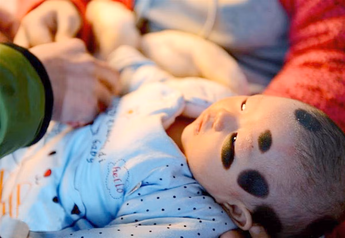 Đốm đen xuất hiện khắp cơ thể bé, rất nhiều ở vai trái và cánh tay phải, nhưng cũng có những đốm to ở đầu và lưng.
