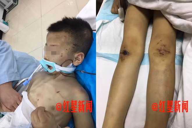Hiện tại, Bằng Bằng sẽ phải chuẩn bị phẫu thuật liên tục, chi phí cũng rất lớn. Rất nhiều mạnh thường quân đã đứng ra từ thiện đồng thời kêu gọi quyên góp cho cậu bé. Cậu bé cũng chỉ ăn được thức ăn lỏng và thường đau đớn không thể ngủ được, phải dỗ dành rất nhiều. Nếu như hồi phục lại, Bằng Bằng cũng sẽ phải cực kỳ nỗ lực trong việc phục hồi các chức năng vật lý. (Nguồn Sina)