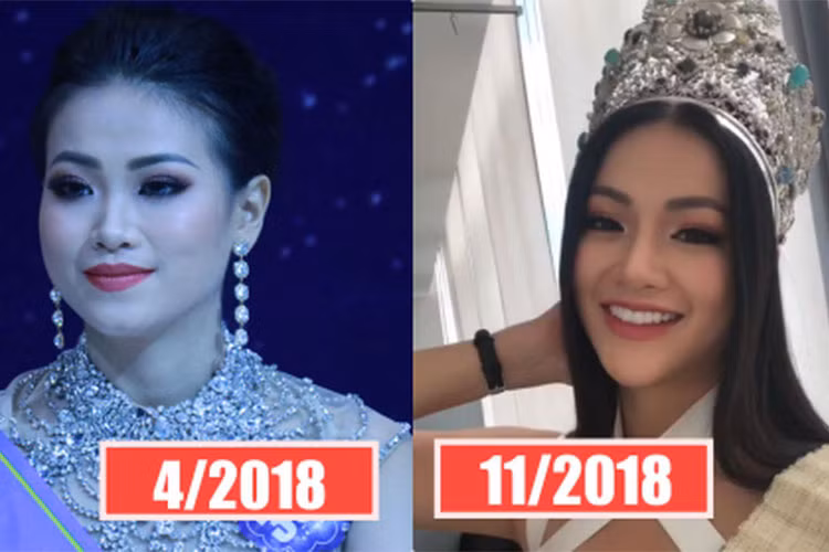 Gương mặt thay đổi chóng mặt của tân Hoa hậu Trái đất Phương Khánh được anh trai của người đẹp cho rằng là do bó mặt. Ảnh: Thế giới trẻ
