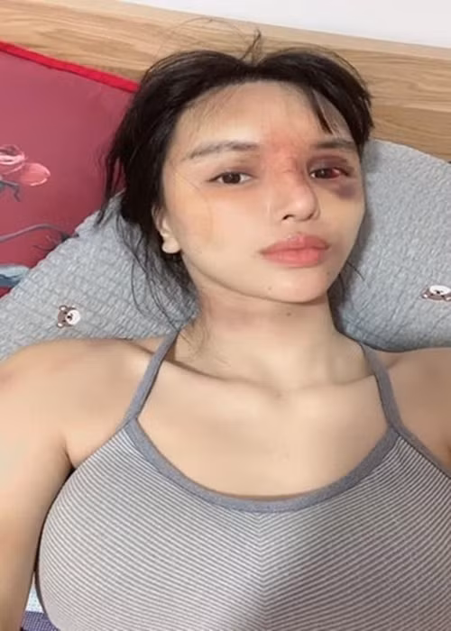 Đáng chú ý, sau xác nhận có con, Khả Trang tung loạt ảnh tố bị bạo hành dã man. Mắt cô đỏ ngầu, mũi như bị gãy, vùng đầu, lưng đều có vết bầm tím. Người đẹp phải nhập viện vì thương tích đầy mình.