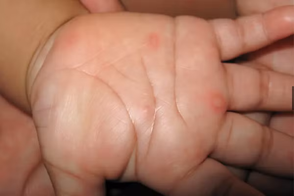 Bệnh tay chân miệng bùng phát: Biến chứng nguy hiểm sao? - Hình 3 Benh tay chan mieng bung phat: Bien chung nguy hiem sao?-Hinh-3