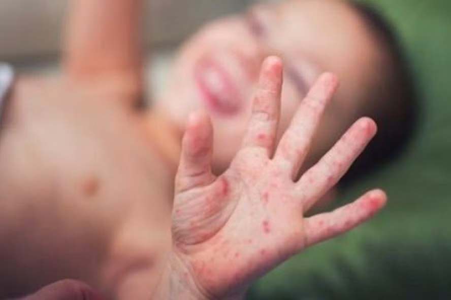 Chủng virus gây đại dịch tay chân miệng năm 2011 đã trở lại? Chung virus gay dai dich tay chan mieng nam 2011 da tro lai?