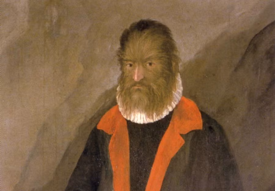 Petrus Gonsalvus (1537 - 1618) tên thật là Pedro Gonzalez là " người sói" nổi tiếng lịch sử. Gonzalez không giống như những người bình thường khi mặc hội chứng hiếm gặp với lông rậm rạp phủ kín cơ thể.