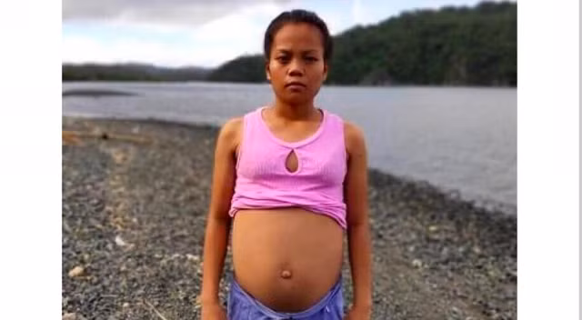 Thieu nu co bung to bat thuong khien dan lang nghi mang thai voi ca